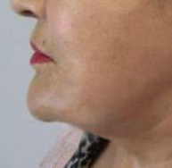 Brow Lift Before & After Patient #8129
