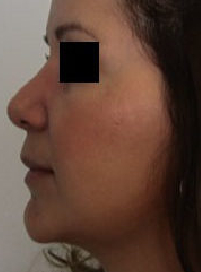 Chin Liposuction Before & After Patient #8345