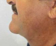 Neck Lift Before & After Patient #10039