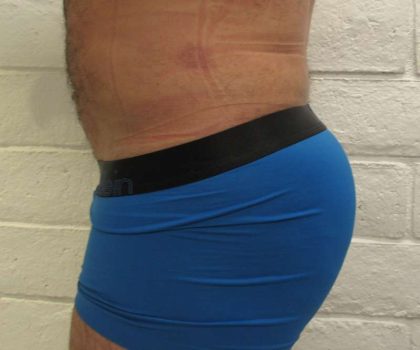 Brazilian Butt Lift Before & After Patient #6223