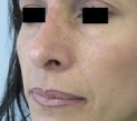 Rhinoplasty Before & After Patient #10313