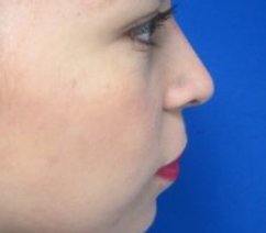 Rhinoplasty Before & After Patient #10306
