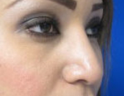 Rhinoplasty Before & After Patient #10269