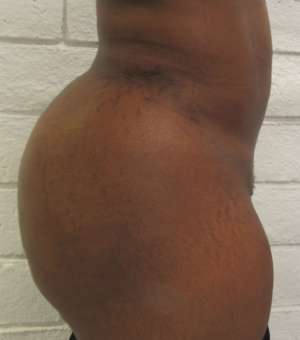 Brazilian Butt Lift Before & After Patient #6312