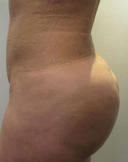 Brazilian Butt Lift Before & After Patient #6358