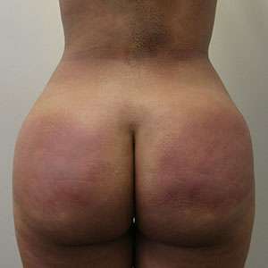 Brazilian Butt Lift Before & After Patient #6369
