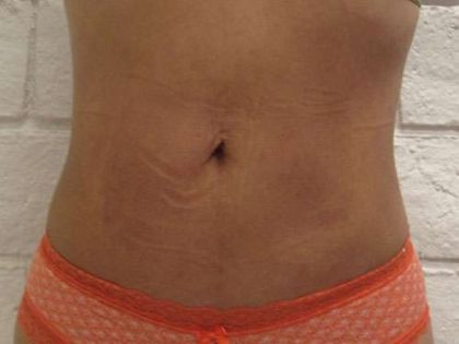 Brazilian Butt Lift Before & After Patient #6378