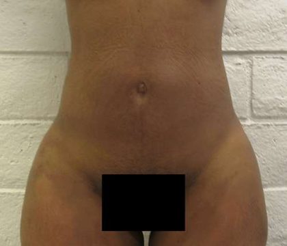 Brazilian Butt Lift Before & After Patient #6390
