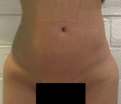 Brazilian Butt Lift Before & After Patient #6395