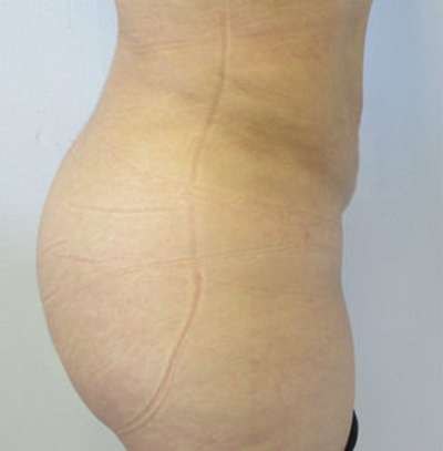 Brazilian Butt Lift Before & After Patient #6408