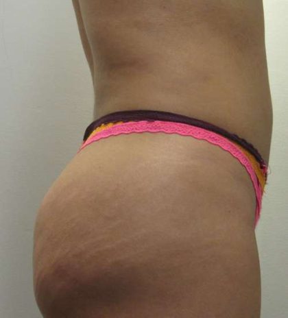 Brazilian Butt Lift Before & After Patient #6443