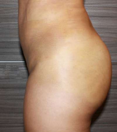 Brazilian Butt Lift Before & After Patient #6449
