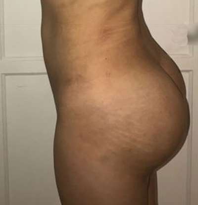 Brazilian Butt Lift Before & After Patient #6455