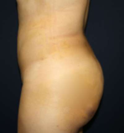 Brazilian Butt Lift Before & After Patient #6524