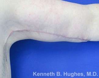 Arm Lift Before & After Patient #5918