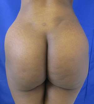 Brazilian Butt Lift Before & After Patient #6548