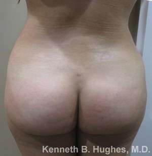Brazilian Butt Lift Before & After Patient #6557