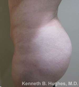 Brazilian Butt Lift Before & After Patient #6567