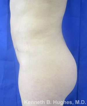 Brazilian Butt Lift Before & After Patient #6575