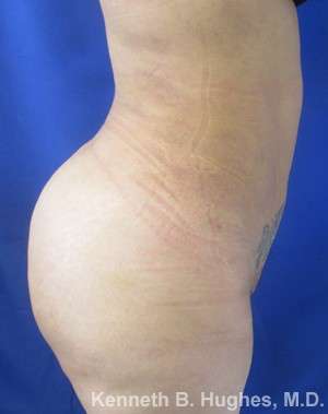 Brazilian Butt Lift Before & After Patient #6582