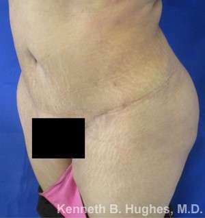 Brazilian Butt Lift Before & After Patient #6616