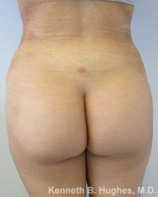 Brazilian Butt Lift Before & After Patient #6637