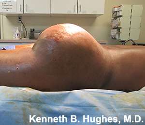 Brazilian Butt Lift Before & After Patient #6647