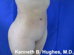 Brazilian Butt Lift Before & After Patient #6660