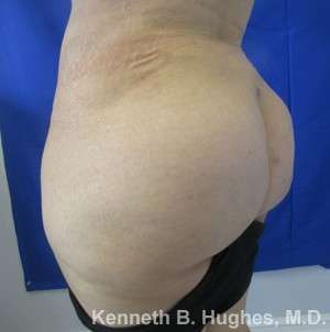 Brazilian Butt Lift Before & After Patient #6673