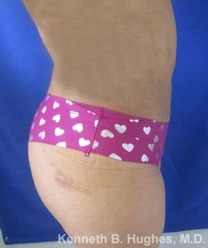 Brazilian Butt Lift Before & After Patient #6691