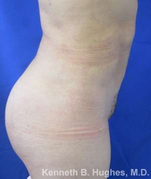 Brazilian Butt Lift Before & After Patient #6702