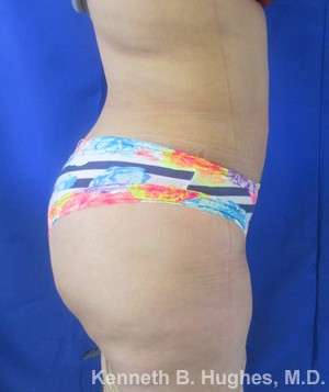 Brazilian Butt Lift Before & After Patient #6733