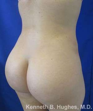 Brazilian Butt Lift Before & After Patient #6738