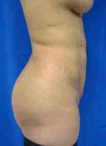 Brazilian Butt Lift Before & After Patient #6760