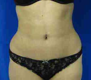 Brazilian Butt Lift Before & After Patient #6804