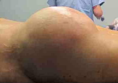 Brazilian Butt Lift Before & After Patient #6809