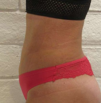 Abdomen Before & After Patient #5907