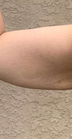 Bodytite Before & After Patient #6164