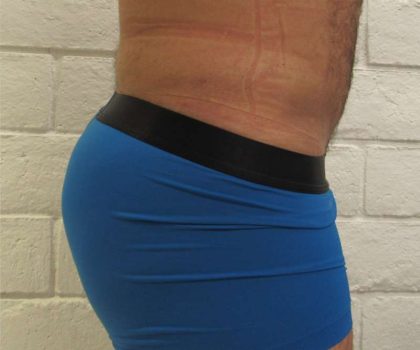 Brazilian Butt Lift Before & After Patient #6223