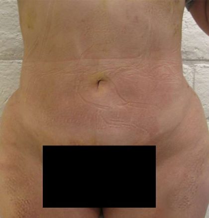 Brazilian Butt Lift Before & After Patient #6248