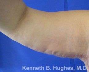 Arm Lift Before & After Patient #5932