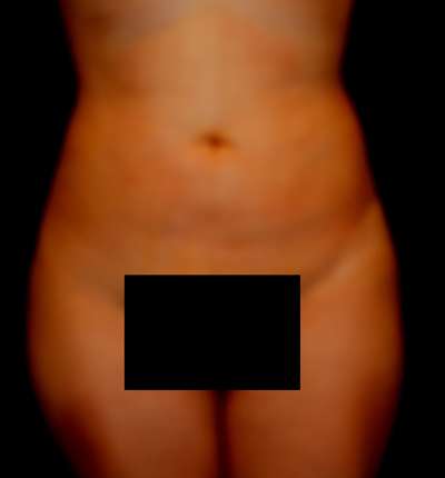 Brazilian Butt Lift Before & After Patient #6524