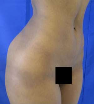 Brazilian Butt Lift Before & After Patient #6548