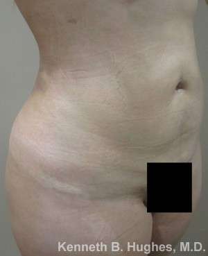 Brazilian Butt Lift Before & After Patient #6557