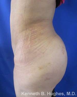 Brazilian Butt Lift Before & After Patient #6582
