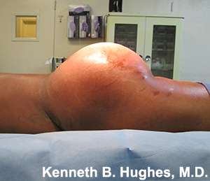 Brazilian Butt Lift Before & After Patient #6647