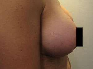Breast Augmentation and Lift Before & After Patient #7177