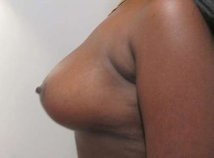 Breast Augmentation and Lift Before & After Patient #7184