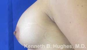 Breast Augmentation Implants Before & After Patient #7236
