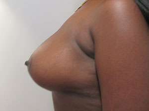 Breast Augmentation Implants Before & After Patient #7611